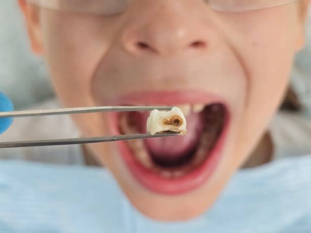 Best Cracked Tooth Emergency Dentist  in Palmetto Bay, FL