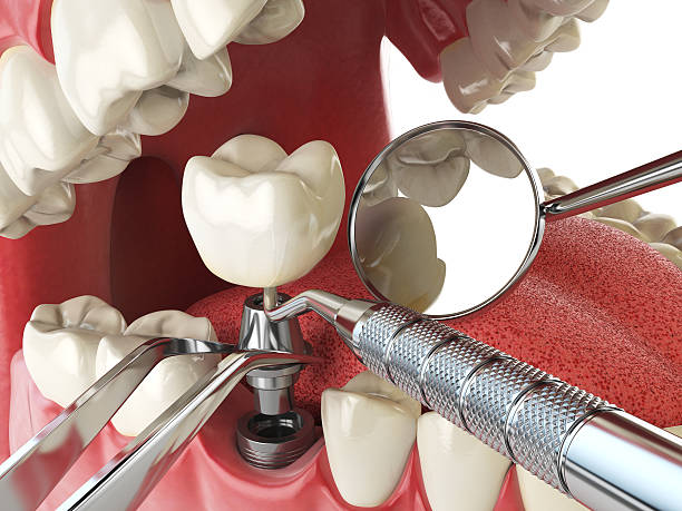 Best Chipped Tooth Repair Near Me  in Palmetto Bay, FL
