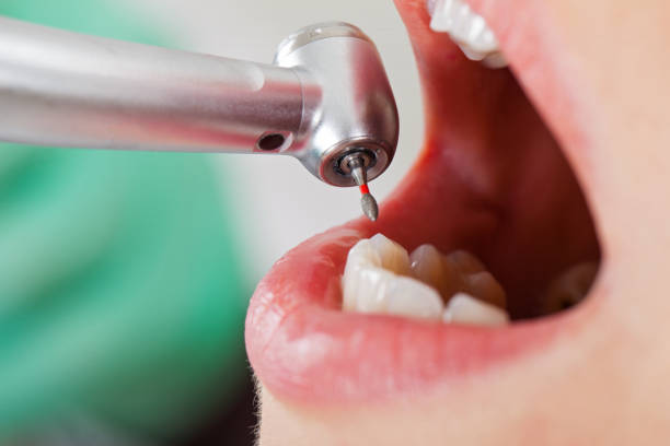 Best Chipped Tooth Repair Near Me  in Palmetto Bay, FL